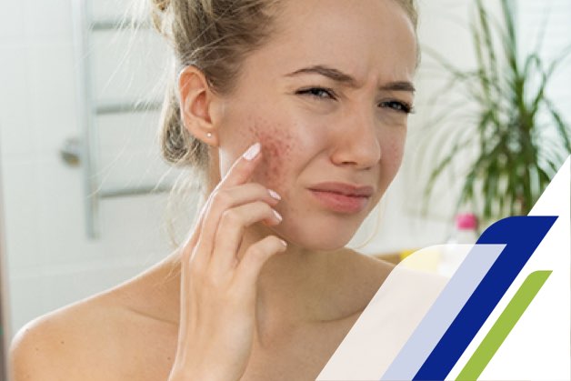 Cómo tratar el acné en la adolescencia paso a paso